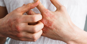 Dermatitas, sausa oda ir kaip su tuo gyventi